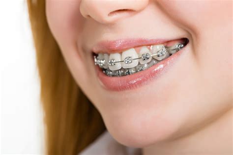 brackets de metal o porcelana|Brackets estéticos vs metálicos: ¿Cuál es la mejor .